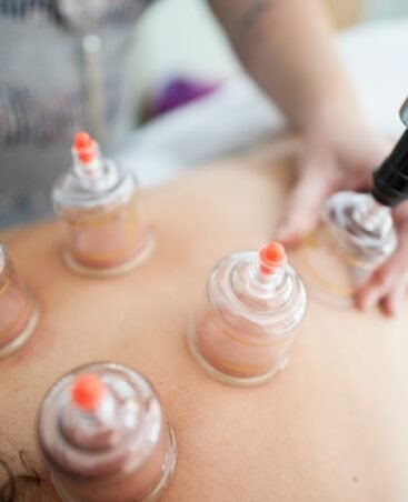 Cupping Therapy in Dubai
