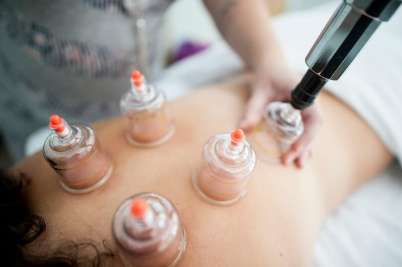 Cupping Therapy in Dubai